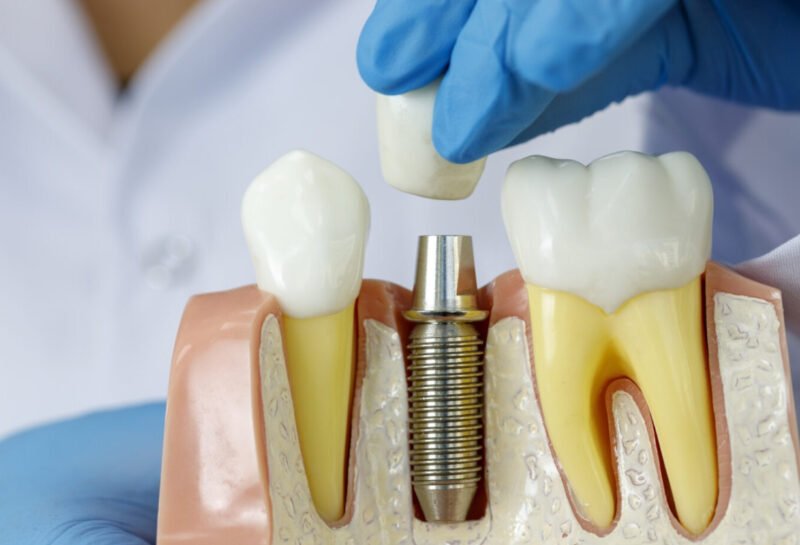 diş implant fiyatları